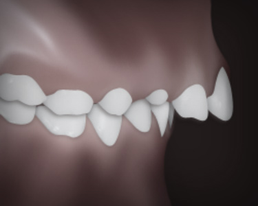 Upper front teeth protrusion