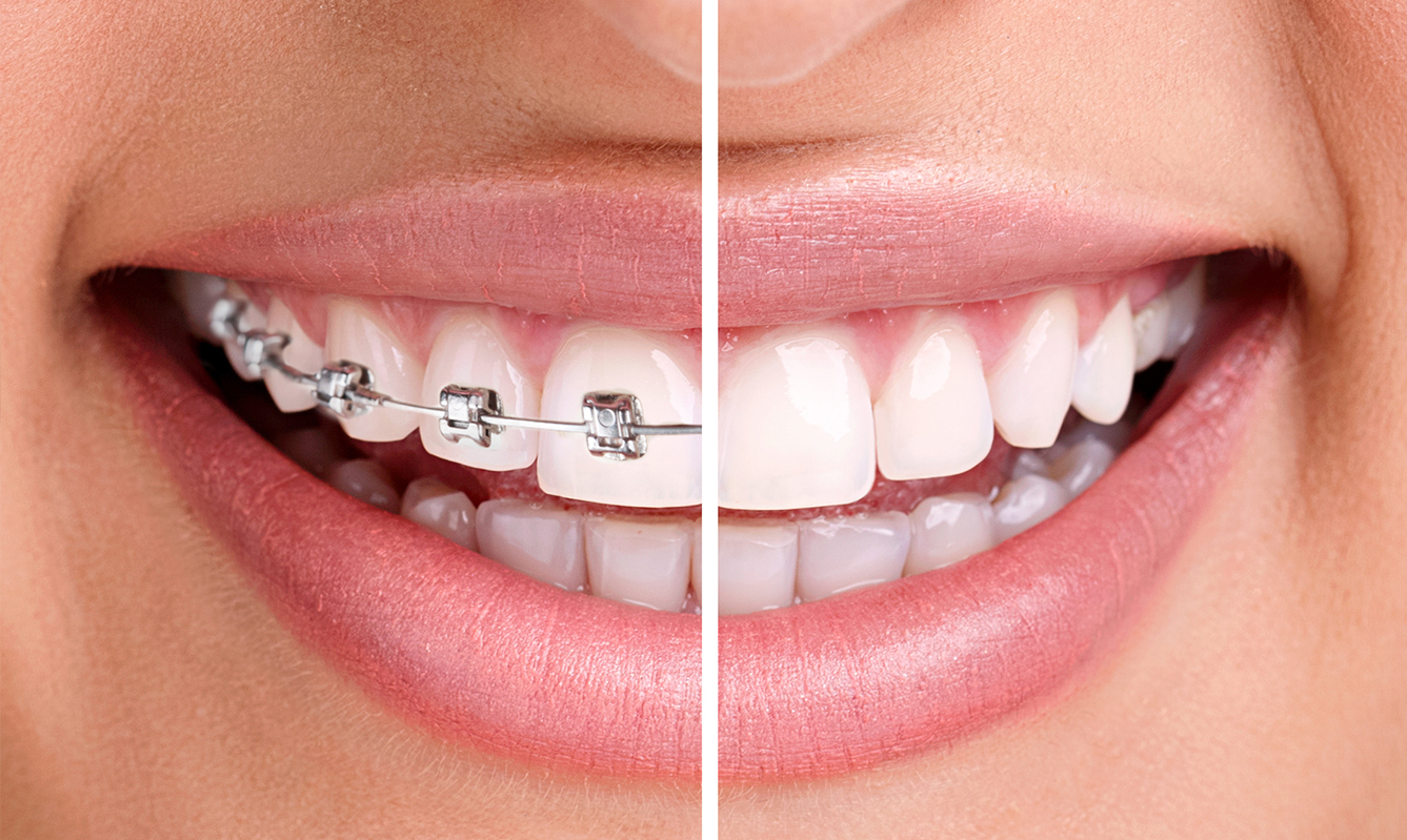 How are Metal and Ceramic Braces Different?