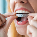The biggest mistake you can make with Invisalign braces