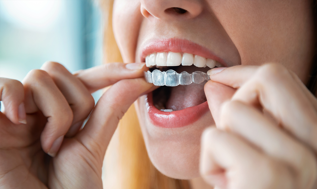 The Biggest MIstake You Can Make with Invisalign Braces