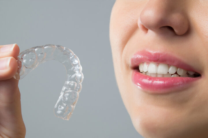 Is the risk of at home dental braces worth it?