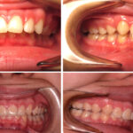 Can you fix an overbite with Invisalign?