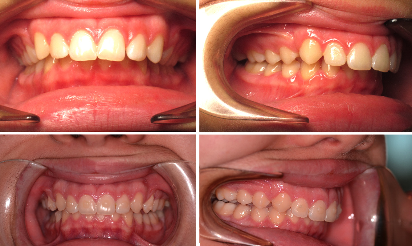 Can you fix an overbite with Invisalign?
