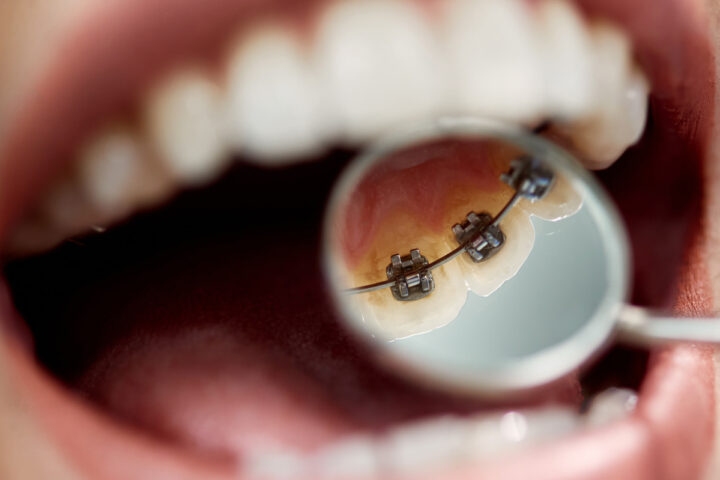 Do lingual braces take longer to straighten teeth?