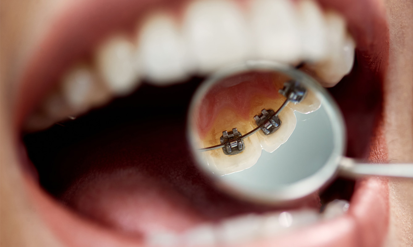 Do lingual braces take longer to straighten teeth?