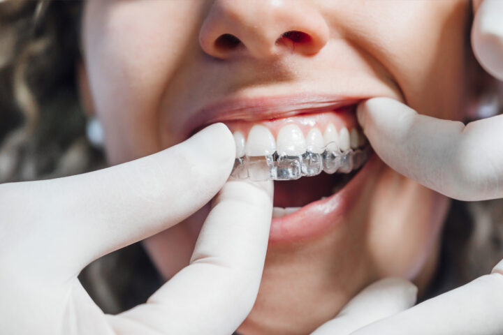 Is Invisalign worth the investment