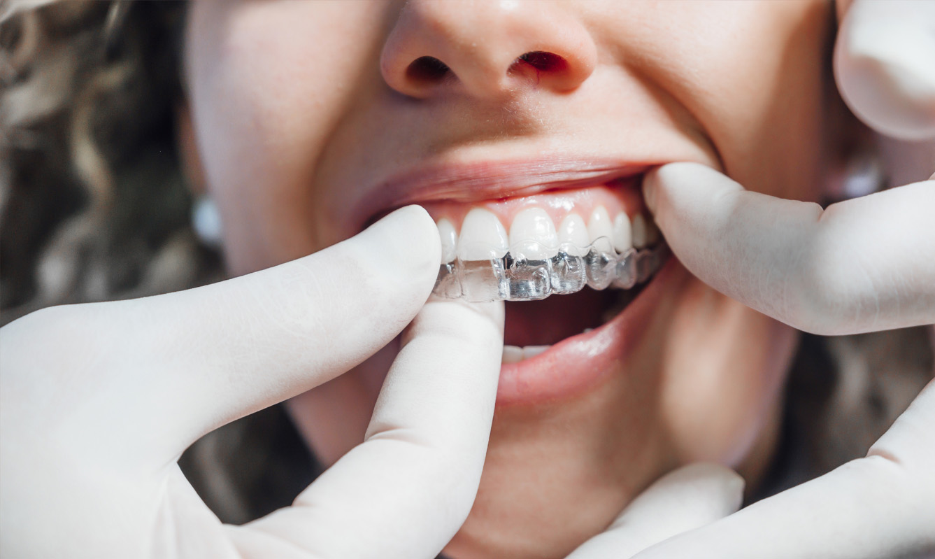 Is Invisalign worth the investment