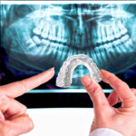 Bruxism and braces