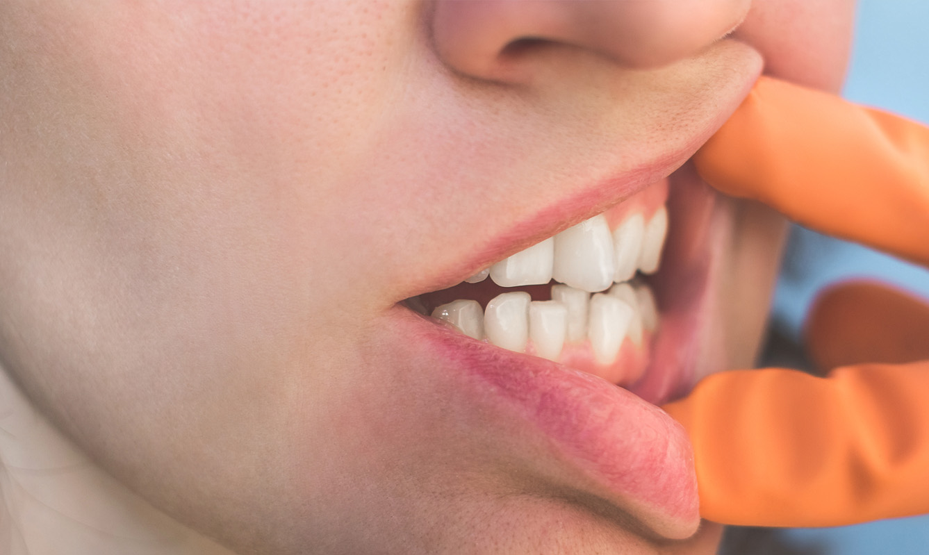 Why your teeth can move after having braces