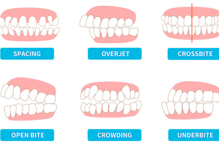 Malocclusion types and treatments