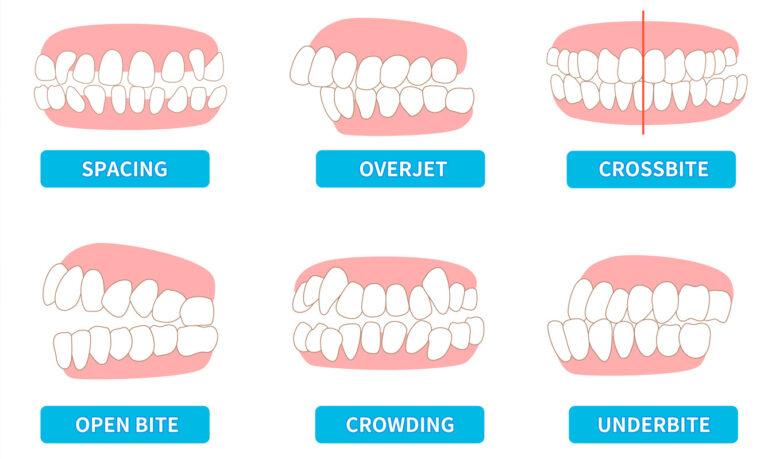 Malocclusion Types And Treatments | Invisible Braces