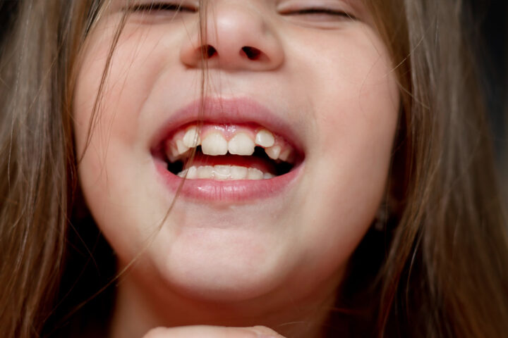 Children's Chewing Problems Could Be a Sign They Need Braces