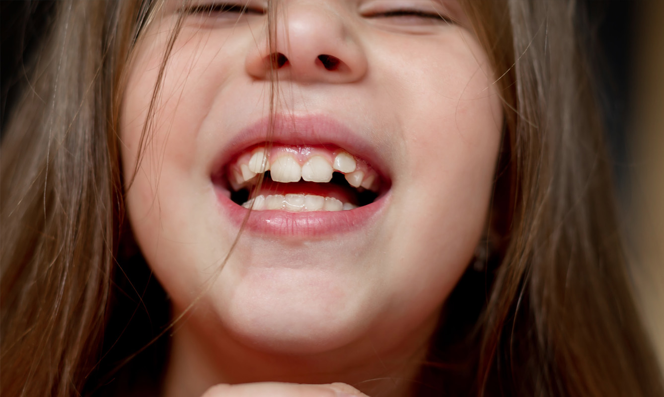 Children's Chewing Problems Could Be a Sign They Need Braces