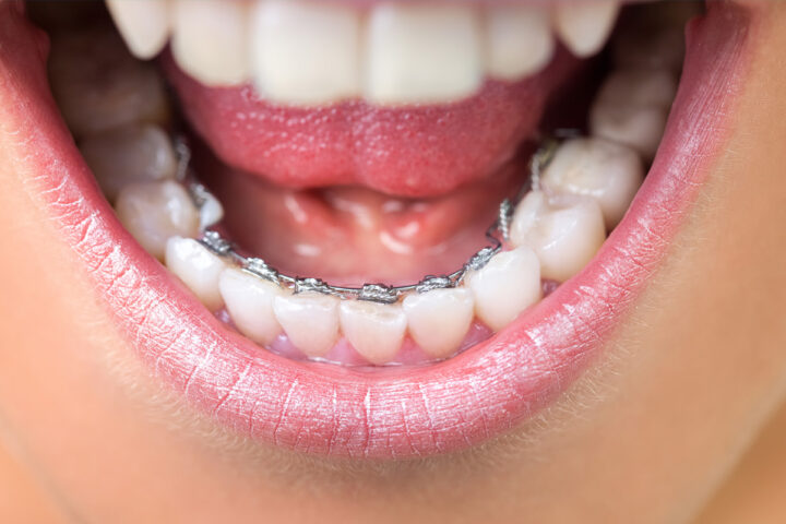 lingual braces
