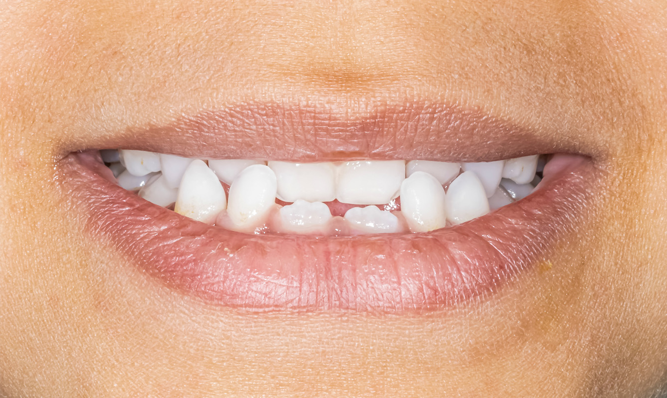 mouith and teeth showing an underbite Class III Malocclusion